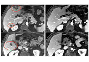 TIL liver mets image